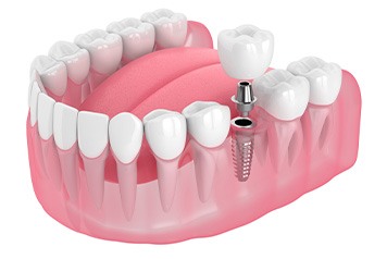 Illustration of single dental implant