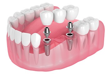 Illustration of implant bridge