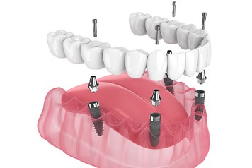 Illustration of implant denture