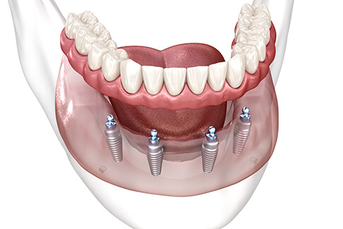 Illustration of All-on-4 dental implants in Lenox, MI