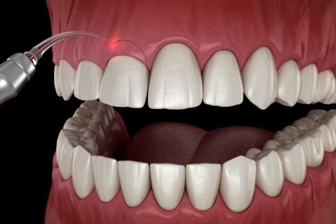 Illustrated dental laser correcting a gummy smile