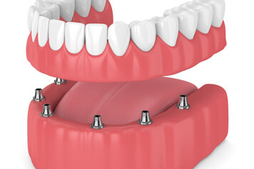 Illustration of implant dentures in Lenox, MI