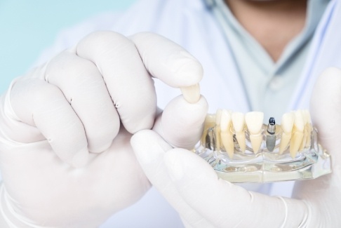 Dentist holding a dental crown and a model of the mouth with a dental implant