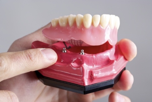 Hand holding a model of an implant denture