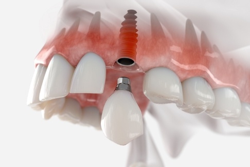 Illustrated dental crown being attached to a dental implant