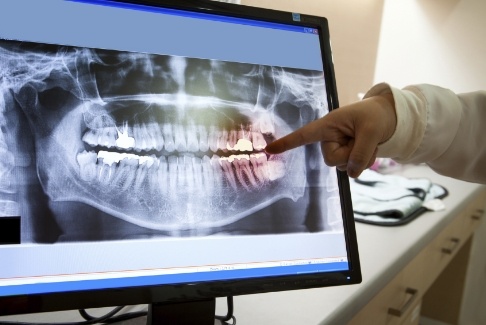 Dentist pointing to x ray of teeth on computer monitor