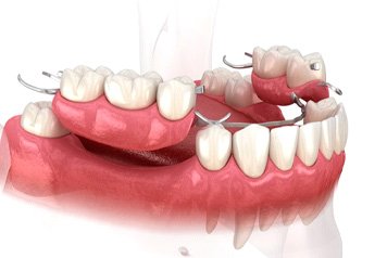 Model of partial denture