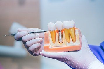 A dental implant model held by a dentist