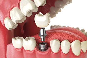 A 3D illustration of a dental implant with its final restoration