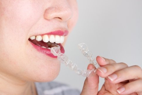 Woman putting Invisalign aligner over her teeth