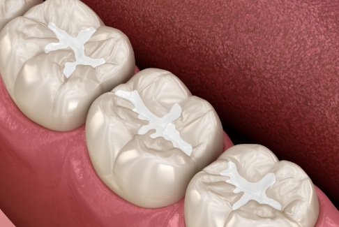 Illustrated row of teeth with natural looking tooth colored fillings