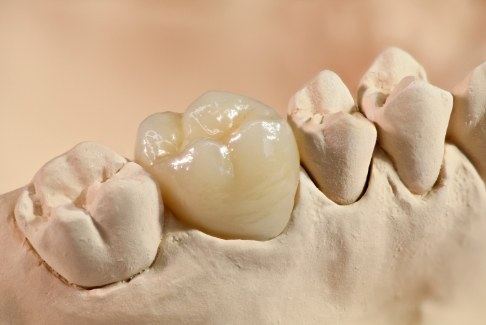 Model of the mouth with a dental crown over one tooth