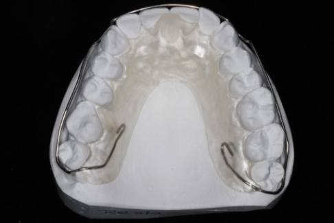 Wire appliance over the palate of a model of the mouth