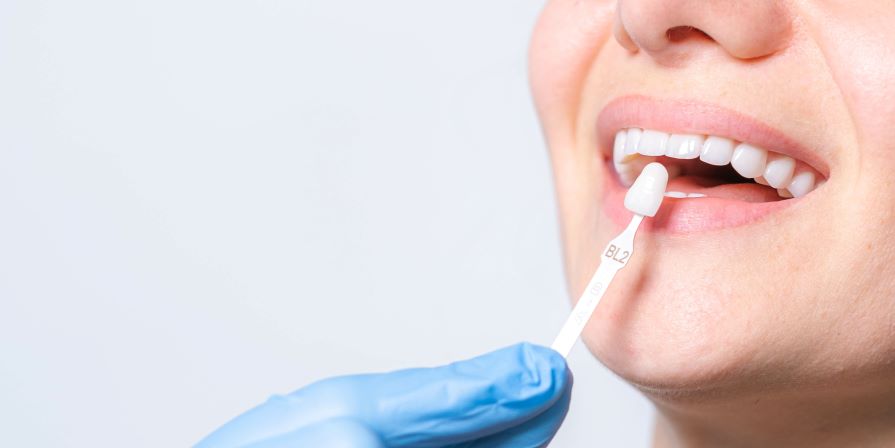 A dentist placing a veneer on a patient’s tooth